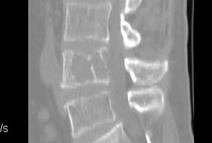 Lumbar Spinal Met CT